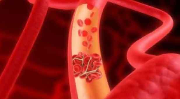 Ridurre i rischi di embolie e trombosi con una sana dieta mediterranea