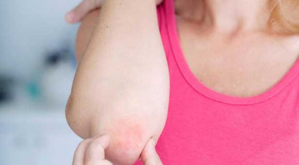 alimentazione-psoriasi